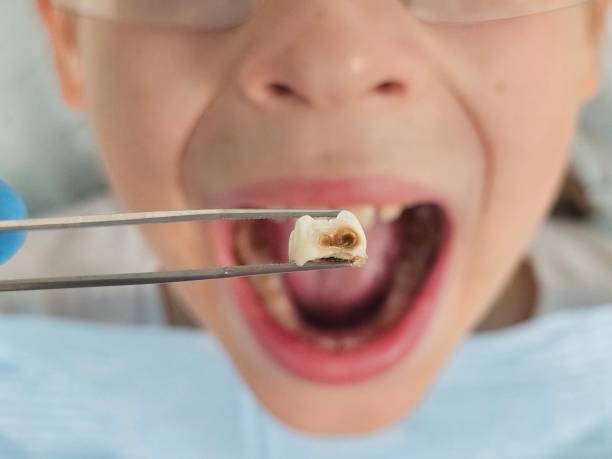 Best Emergency Treatment for Oral Infections in North Liberty, IN